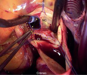 Imagen intraoperatoria de la válvula aórtica, que muestra perforación del velo no coronario. Las suturas (azules) delimitan las 3 comisuras. El aspirador de la izquierda se introduce a través de la rotura del velo. El aspirador de la derecha está sobre el anillo del velo roto que se abre en forma de V casi impidiendo ver los velos coronarios izquierdo y derecho. La pinza sostiene un borde del velo roto, que debería unirse a la otra mitad del velo, es decir a la comisura que está a las doce. AD: aurícula derecha; Caudo: caudal; CD: coronaria derecha; CI: coronaria izquierda; NC: no coronario. Esta figura se muestra a todo color solo en la versión electrónica del artículo.