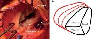 Anatomía de la válvula tricúspide en la insuficiencia tricuspídea funcional. A: imagen quirúrgica de un anillo tricuspídeo dilatado. B: dilatación progresiva del anillo tricuspídeo en la insuficiencia tricuspídea funcional.
