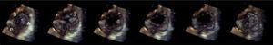 Imagen de ecocardiografía transesofágica 3D de la válvula tricúspide a lo largo del ciclo cardiaco. A: valva anterior; P: valva posterior; S: valva septal.
