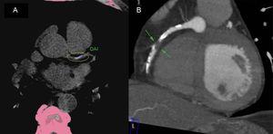 A: ejemplo de obtención de la puntuación de calcio coronario. B. TCMD con contraste que muestra una estenosis luminal intensa en la arteria coronaria derecha (flechas). DAI: arteria descendente anterior izquierda; TCMD: tomografía computarizada multidetector.
