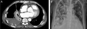 A: tomografía computarizada del paciente 1, con drenaje endotorácico correctamente posicionado. B: radiografía simple de tórax del paciente 2 antes de la colocación de drenaje endotorácico.