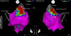 Mapa de voltaje del ventrículo derecho en una imagen anterior (AP) y posterior (PA). Se identifica una zona de escara a nivel de la válvula pulmonar hasta el tracto de salida anterior (cicatriz de ventriculotomía y resección infundibular) y otra zona de cicatriz septal posterior en relación con el parche de cierre de la CIV. Los puntos en amarillo señalan el His. CIV: comunicación interventricular; V: válvula. Esta figura se muestra a todo color solo en la versión electrónica del artículo.