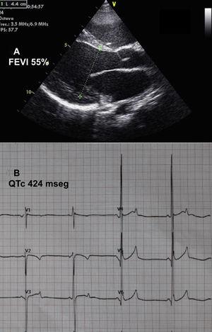 Ecocardiografía (A) y electrocardiografía (B) después del tratamiento. FEVI: fracción de eyección del ventrículo izquierdo.