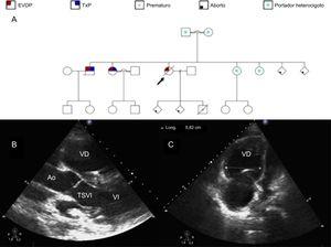 A: árbol genealógico familiar; la flecha negra identifica a nuestra paciente. B: ecocardiografía transtorácica parasternal, en proyección de eje largo; VD muy dilatado e hipertrófico. C: ecocardiografía transtorácica, con imagen de 4 cámaras; VD muy dilatado. AO: aorta; EVOP: enfermedad venooclusiva pulmonar; TSVI: tracto de salida del VI; TxP: trasplante pulmonar; VD: ventrículo derecho; VI: ventrículo izquierdo.