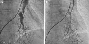 A: fase venosa no visible antes de la angioplastia con balón de las arterias pulmonares. B: retorno venoso visible a aurícula izquierda tras la angioplastia con balón de las arterias pulmonares.