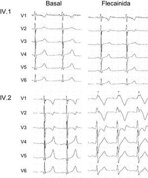 Registros electrocardiográficos (V1-V6) del paciente IV.1 (arriba) y del paciente IV.2 (abajo) antes (control) y a los 10min de recibir una infusión intravenosa de flecainida 2 mg/kg.