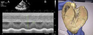 Imagen ecocardiográfica en modo M (A) y macroscópica (B) del corazón de un varón de 14 años con enfermedad de Danon e hipertrofia del ventrículo izquierdo masiva (septo interventricular de 43 mm). Imagen macroscópica cortesía de la Dra. Elena Ruiz del Hospital La Paz.