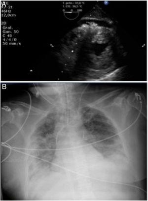 A: ecocardiograma; edema miocárdico y derrame pericárdico. B: radiografía de tórax que muestra la disnea.