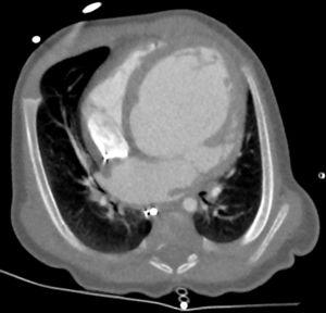 Imagen de angiografía mediante tomografía computarizada cardiaca multidetectores estimulada por electrocardiograma retrospectivo que muestra una marcada dilatación del ventrículo izquierdo.