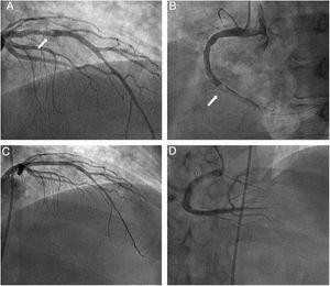 A: trombo en la arteria coronaria descendente anterior proximal. B: trombo en la arteria coronaria derecha. C: descendente anterior tras la colocación del stent. D: coronaria derecha tras la colocación del stent.
