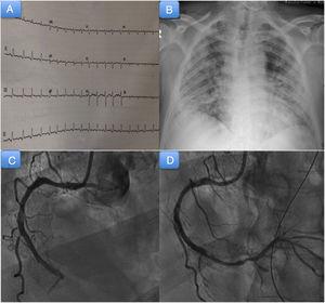 A: electrocardiograma al ingreso. B: radiografía de tórax al ingreso. C: coronariografía; se observa oclusión trombótica de la coronaria derecha medio-distal. D: coronariografía; se observa oclusión de la descendente posterior tras la migración del trombo.