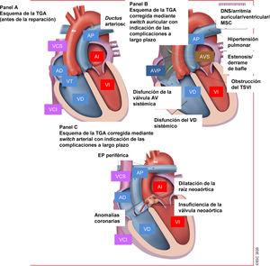 Tratamiento de la transposición de las grandes arterias: complicaciones a largo plazo que atender en el seguimiento. AD: aurícula derecha; AI: aurícula izquierda; Ao: aorta; AV: auriculoventricular; AVP: aurícula venosa pulmonar; AVS: aurícula venosa sistémica; DNS: disfunción del nódulo sinusal; EP: estenosis pulmonar (rama arterial pulmonar/supravalvular); <span class=