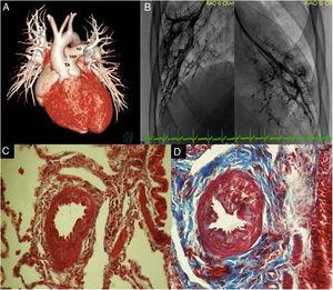 A: reconstrucción 3D. Tronco arterioso común tipo I. B: angiografías pulmonares magnificadas en cuña con mancha capilar derecha e izquierda. C: tinción de Masson. Biopsia pulmonar derecha, con proliferación de la pared por hiperplasia de musculo liso (rojo); grado I de Heath y Edwards. D: biopsia pulmonar izquierda, con engrosamiento de la pared vascular por músculo liso (rojo) y proliferación de la íntima, con tejido fibroso (azul); grado II de Heath y Edwards. RD: rama pulmonar derecha; RI: rama pulmonar izquierda; TA: tronco arterioso común, TAP: tronco arterial pulmonar. Esta figura se muestra a todo color solo en la versión electrónica del artículo.