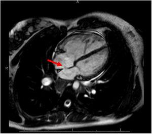 Imagen de 4 cámaras en secuencia cine de resonancia magnética cardiaca. Se puede observar un pequeño defecto a nivel del septo interauricular, además de paso de flujo en relación con un cortocircuito sistémico-pulmonar (flecha). Destaca la dilatación de la aurícula y el ventrículo derechos.