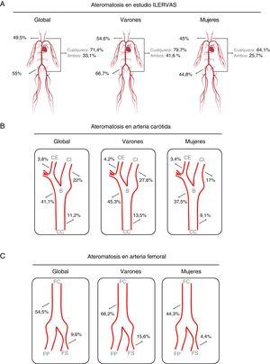 Prevalencia de la ateromatosis subclínica en los diversos territorios vasculares en el estudio ILERVAS. Territorios de distribución global (A), de arteria carótida (B) y de arteria femoral (C). B: bifurcación carotídea; CC: carótida común; CE: carótida externa; CI: carótida interna; FC: femoral común; FP: arteria femoral profunda; FS: arteria femoral superficial.