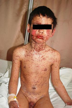 Vesiculo-bullous skin and mucous membrane lesions with detachment of epidermis.