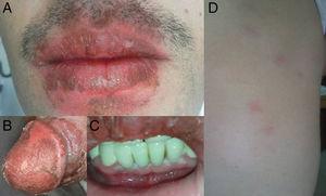 Multifocal bullous fixed drug eruption. Vesiculobullous lesions and erosions on the lips (A), penis (B), gingivae (C) and also erythematous/violaceous plaques on the scapula (D) of the patient.
