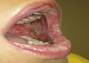 Case 1. STS. Erythema, swelling, erosions and pseudomembranes in oral and labial mucosa.