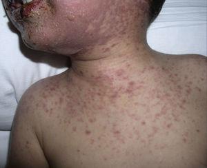 Case 2. TEN. Generalised maculopapular rash erythematous, coalescent on face and neck, with blisters and areas denuded skin and mucosa.