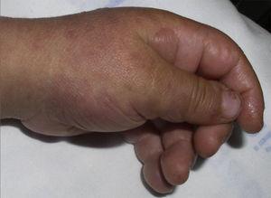 Case 2. TEN. Erythema, oedema, vesicles and blisters on hands and fingers.