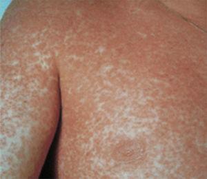Case 3. DRESS. Non-specific disseminated morbilliform maculopapular rash.