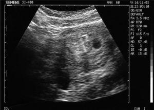 DIU intrauterino visualizado mediante ecografía adyacente al saco gestacional.