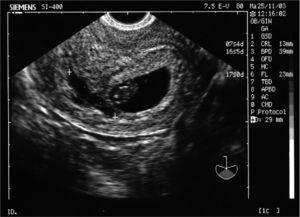 Líquido intrauterino postextracción de DIU y saco gestacional con embrión en su interior.