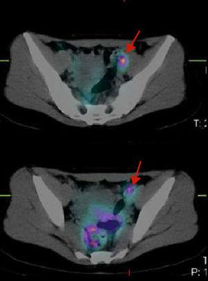 Visualización de ganglios linfáticos ilíacos externos mediante SPECT-TAC, previa a la biopsia de ganglio centinela.