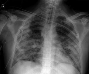 Radiografía de paciente con COVID. Obsérvese los extensos infiltrados intersticiales bilaterales.