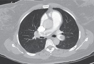 Tromboembolismo pulmonar masivo bilateral (tomografía computarizada de tórax). Imagen cedida por la Dra. Aída Gutiérrez.
