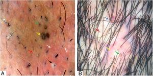 (A) Broken hairs (blue arrow), short regrowing hairs (red arrow), black dots (green arrow), large brown dots (yellow arrow), follicular pustules (black arrow), interfollicular erythema (white arrow), and empty follicular openings (gray arrow). (B) Skin clefts with emergent hairs (blue arrow), yellow dots (red arrow), “3D” yellow dots (green arrow), and peri- and interfollicular erythema (yellow arrow). Trichoscopy performed with 3Gen DermLite® II Hybrid M with polarized light with interface liquid (alcohol 70%); ×20 magnification.