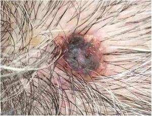 Blackened nodule upon erythematous base with central crust at the apex of the scalp.