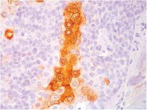 Immunohistochemical staining of the skin biopsy: positivity in the immunohistochemical reaction with the anti-EMA antibody in a cytoplasmic reticular pattern around the lipid vacuoles (original magnification of ×400).