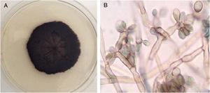 Macro-microscopic morphology compatible with Rhinocladiella sp. (A) Sabouraud culture demonstrates limited, hairy, velvety, and black-colored colony. (B) Septate conidiophores with multiple sympodial elliptical conidia with fine walls, showing acropleurogenous conformation.