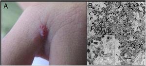 Bacillary angiomatosis: (A) single angiomatous lesion on the third interdigit of the right hand of a woman; (B) electron microscopy of cutaneous fragment transmission with innumerable Gram-negative bacilli featuring intra- and extracellular distribution (1200×, inset 16,000×).