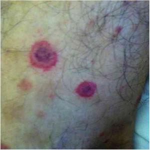 Cutaneous vasculitis on the leg of a 42-year-old man with a history of cat scratches and fever, with a diagnosis of B. henselae endocarditis confirmed by polymerase chain reaction, serology, and culture.