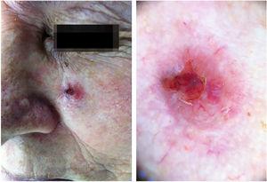 Clinical and dermatoscopic aspect (×20 magnification) of basal cell carcinoma located in the left malar region.
