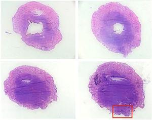 Horizontal histological sections of the debulking (hematoxylin-eosin, ×20). Top left image corresponding to the surface incision and lower right image to the deepest incision. Highlighted lateral margin involvement (red rectangle).