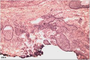 Microscopic view of the horizontal histological incision with compromised margin (hematoxylin-eosin, ×100).