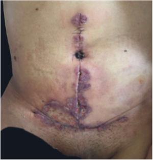 Pyoderma gangrenosum after abdominoplasty.
