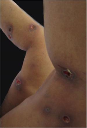 Multiple pyoderma gangrenosum ulcers at the sites of sclerotherapy injections.