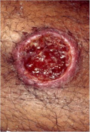 Cutaneous leishmaniasis lesions can mimic classic pyoderma gangrenosum lesions.