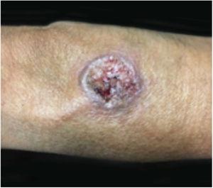 Cutaneous leishmaniasis lesions can mimic classic pyoderma gangrenosum lesions.