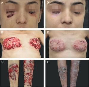 Skin lesions before (right) and after (left) six months of treatment.