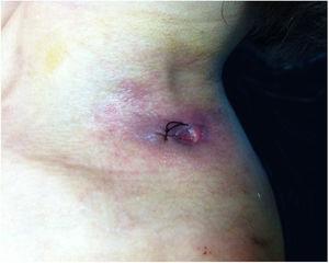 Ulcer on the left shoulder. The cutaneous ulcer on her left shoulder, after a skin biopsy.