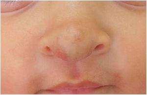 After the treatment with oral propranolol, 9-month-old infant.