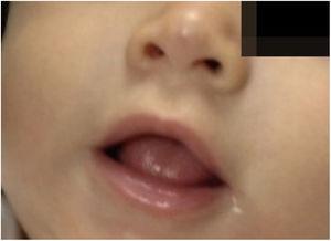 After the treatment with oral propranolol, 5-month-old infant.
