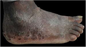 Lateral aspect of right foot after seven months of treatment, showing lesions regression.