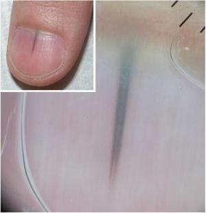Clinic and dermoscopy (Case 2). Dermoscopy of the nail plate shows irregular bands of triangular-shaped pigmentation with a bluish-gray color and wider in the proximal and dark brown and finer portions in the distal portion.