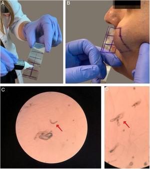 Performing the microscopic examination of mites was performed by cyanoacrylate glue Standardized Skin Surface Biopsy (SSSB). (A) Preparation of the slide covered with cyanoacrylate glue; (B) Collection of the sample from the cheek; (C and D) Microscopic examination of the Demodex mites (×40).